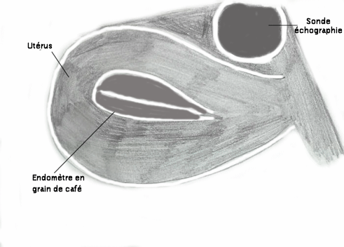 echo_endometre_schema