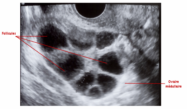 Echographie de l'utérus et des ovaires - Natisens