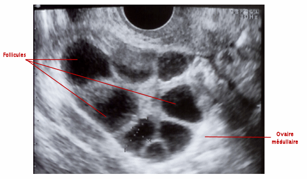 Follicule Visible L chographie FJEHC Follicule Visible L chographie FJEHC