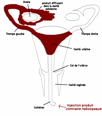 hsg_schema