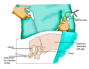 laparoscopy